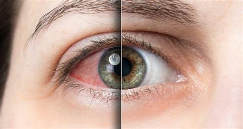 Co się stanie, jeśli oczy zmaleją z powodu zimna? Jak i jak leczyć ten objaw?